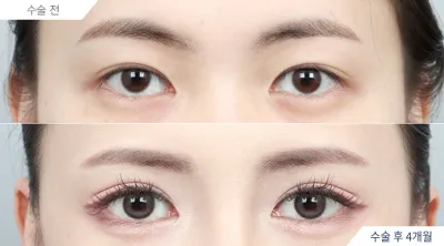 Before & After