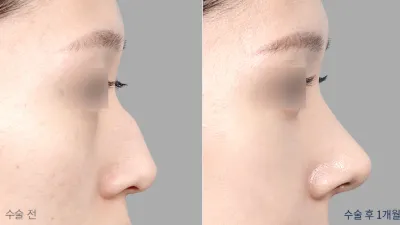 Before & After