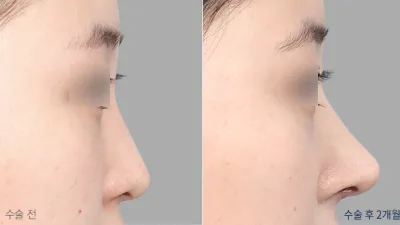 Before & After