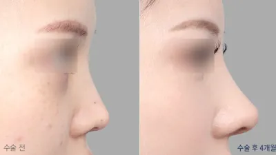 Before & After