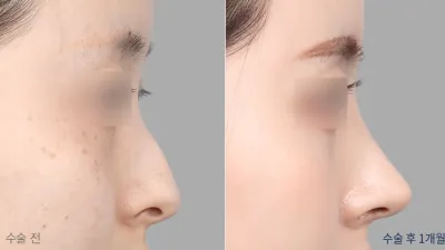 Before & After