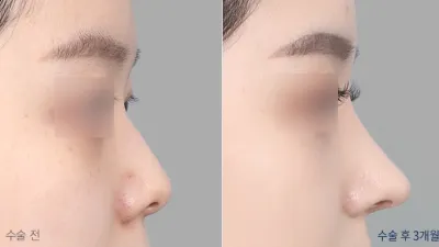 Before & After