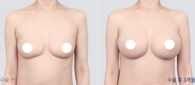 Before & After