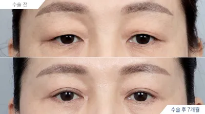 Before & After