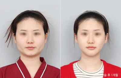 Before & After