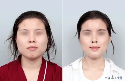 Before & After