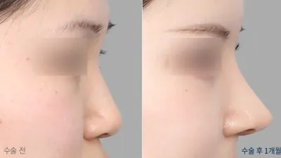 Before & After