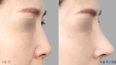 Before & After