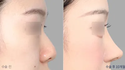 Before & After
