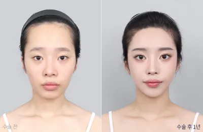 Before & After
