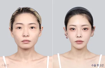 Before & After