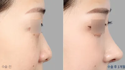 Before & After