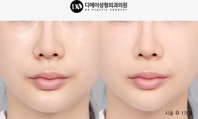 Before & After