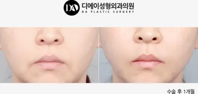 Before & After
