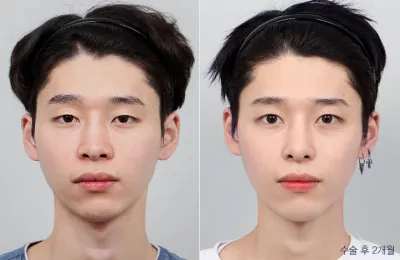 Before & After