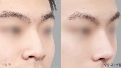 Before & After