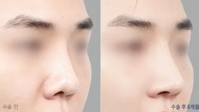 Before & After