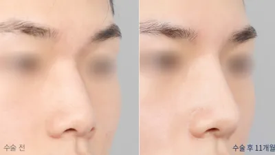 Before & After