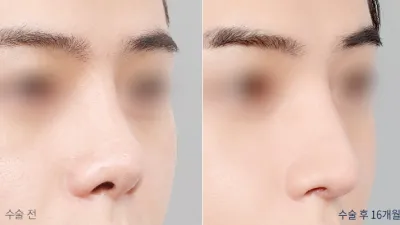 Before & After