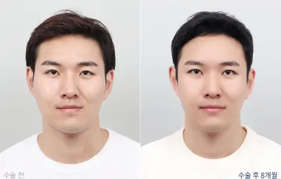 Before & After