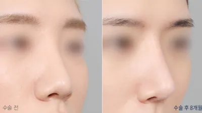 Before & After