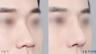 Before & After