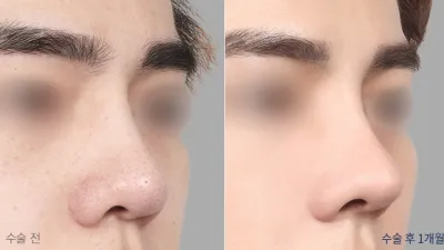 Before & After
