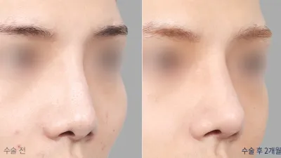 Before & After