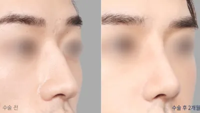 Before & After