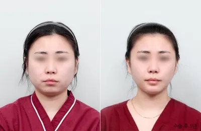 Before & After