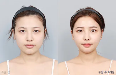 Before & After