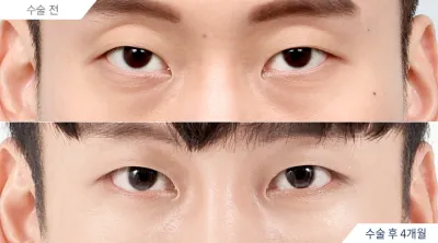 Before & After