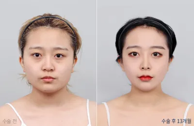Before & After