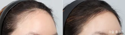Before & After