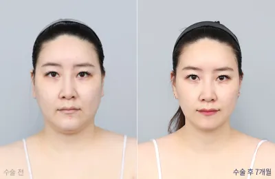 Before & After