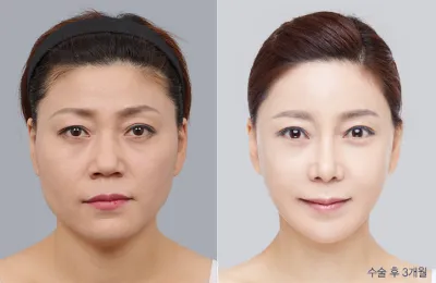 Before & After