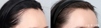 Before & After