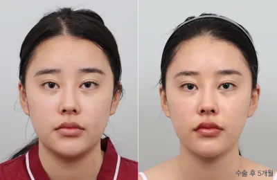 Before & After