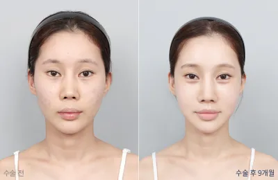 Before & After