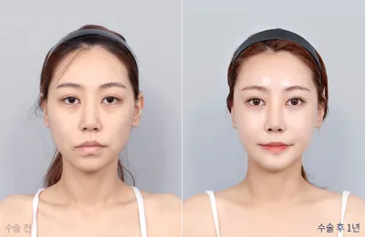 Before & After