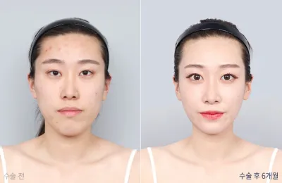 Before & After