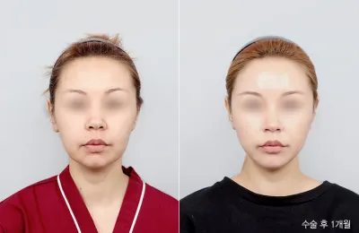 Before & After