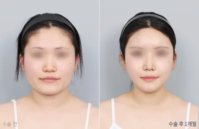 Before & After