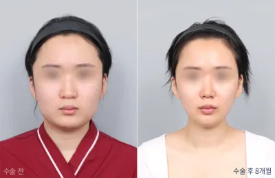 Before & After