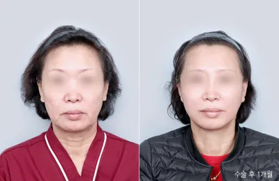 Before & After
