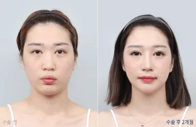Before & After