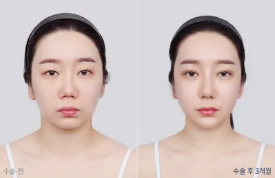 Before & After