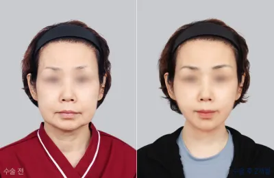 Before & After
