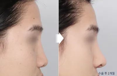 Before & After
