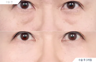 Before & After